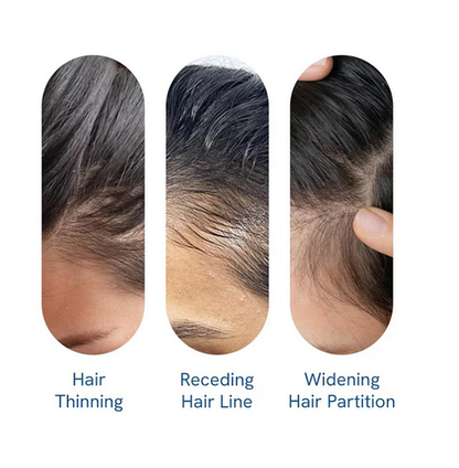 Be Bodywise Advanced Hair Growth Roll-On Serum | 3% Rosemary | 2% Aminexil | 3% Redensy l 2% Anagain | Precision Scalp Applicator | Paraben & Sulphate Free | Non oily and mess free